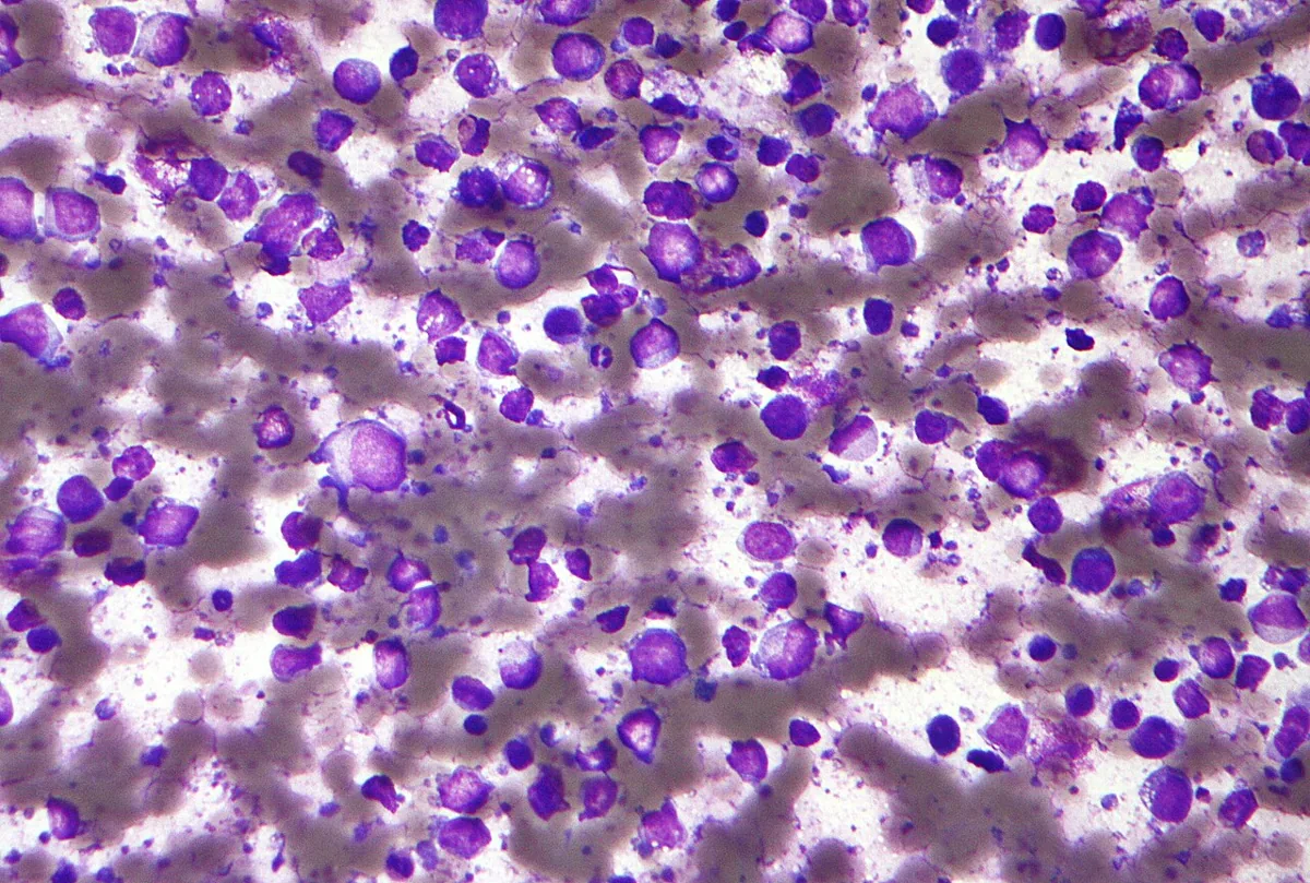Non-Hodgkin lymphomas – Fine-needle cytology of diffuse large B-cell lymphoma: numerous large atypical lymphoid cells