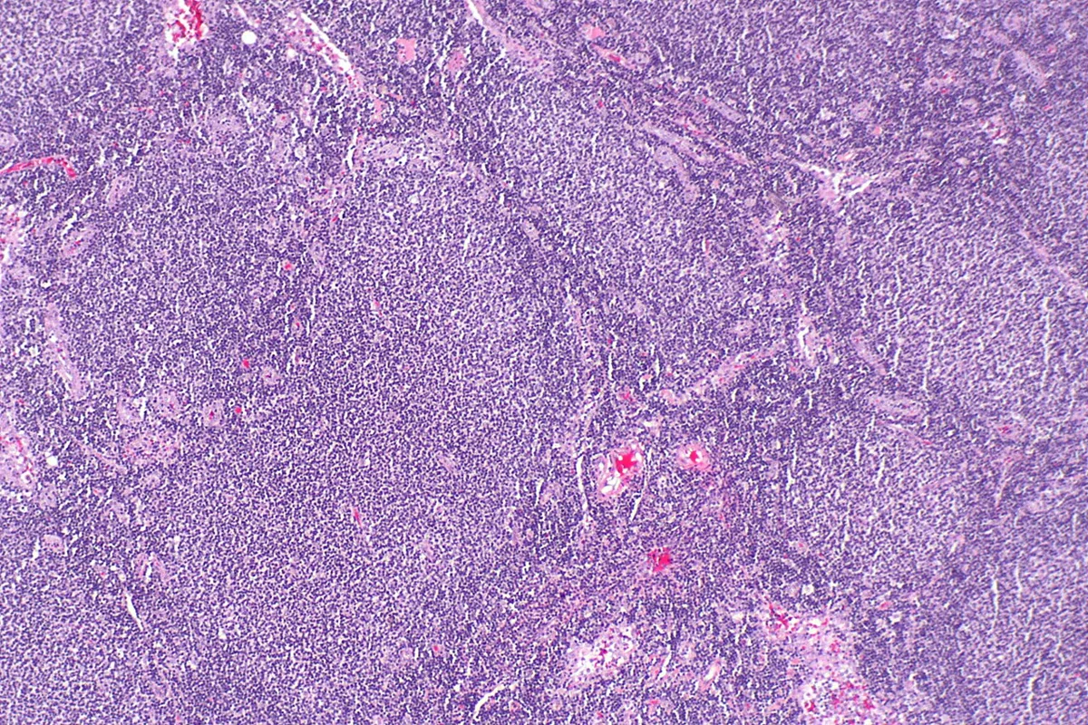 Non-Hodgkin lymphomas – Histology of follicular lymphoma: crowded, uniform neoplastic follicles replacing the lymph node architecture