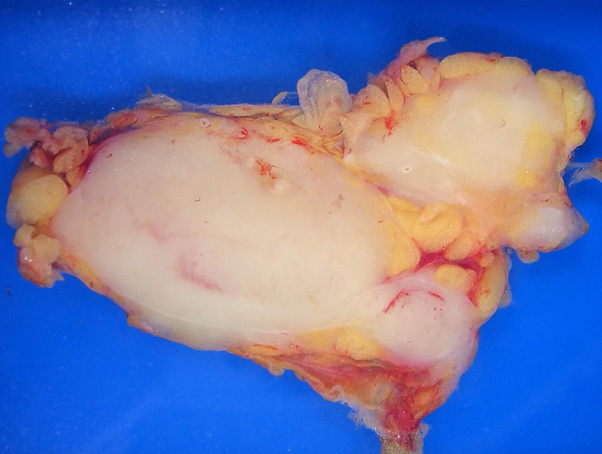 Non-Hodgkin lymphomas – gross specimen: Cut surface of a lymph node completely infiltrated by lymphoma: homogeneous whitish-yellow, fish-flesh-like tissue