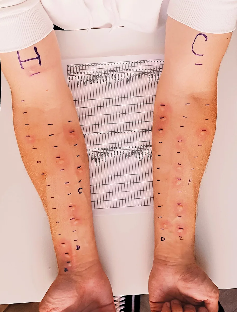 Food allergy – clinical photo: Skin prick test on both forearms: several positive reactions with wheal and flare at the marked test sites