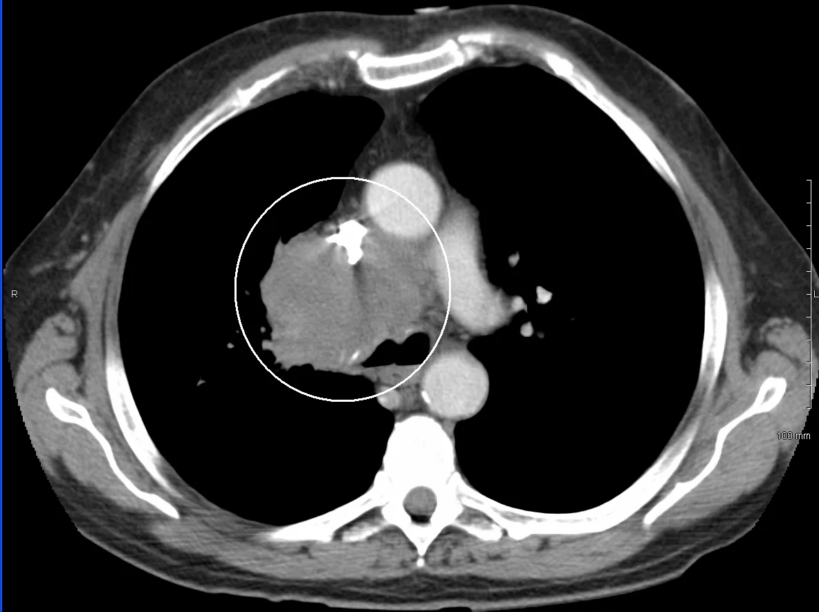 Superior vena cava syndrome – Chest CT: right hilar tumor mass (circle) compressing the superior vena cava