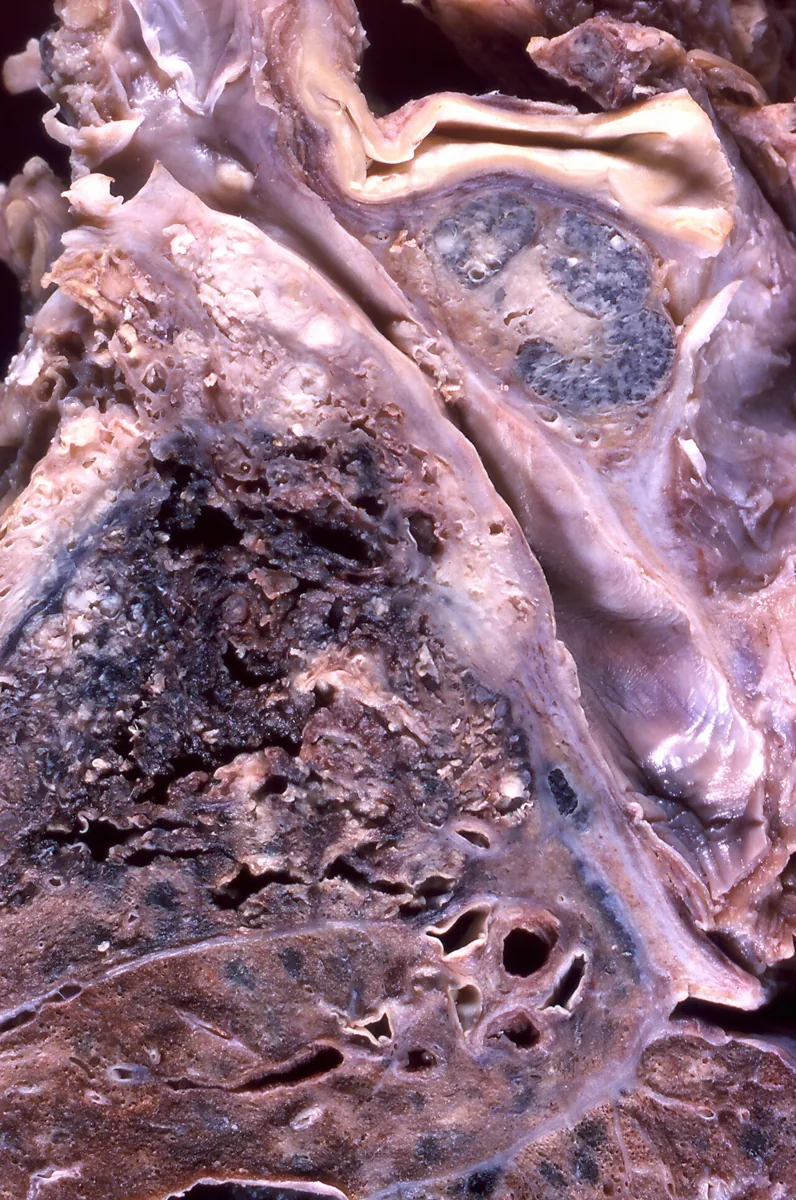 Superior vena cava syndrome – gross specimen: Autopsy specimen: small cell lung carcinoma encasing and obstructing the superior vena cava