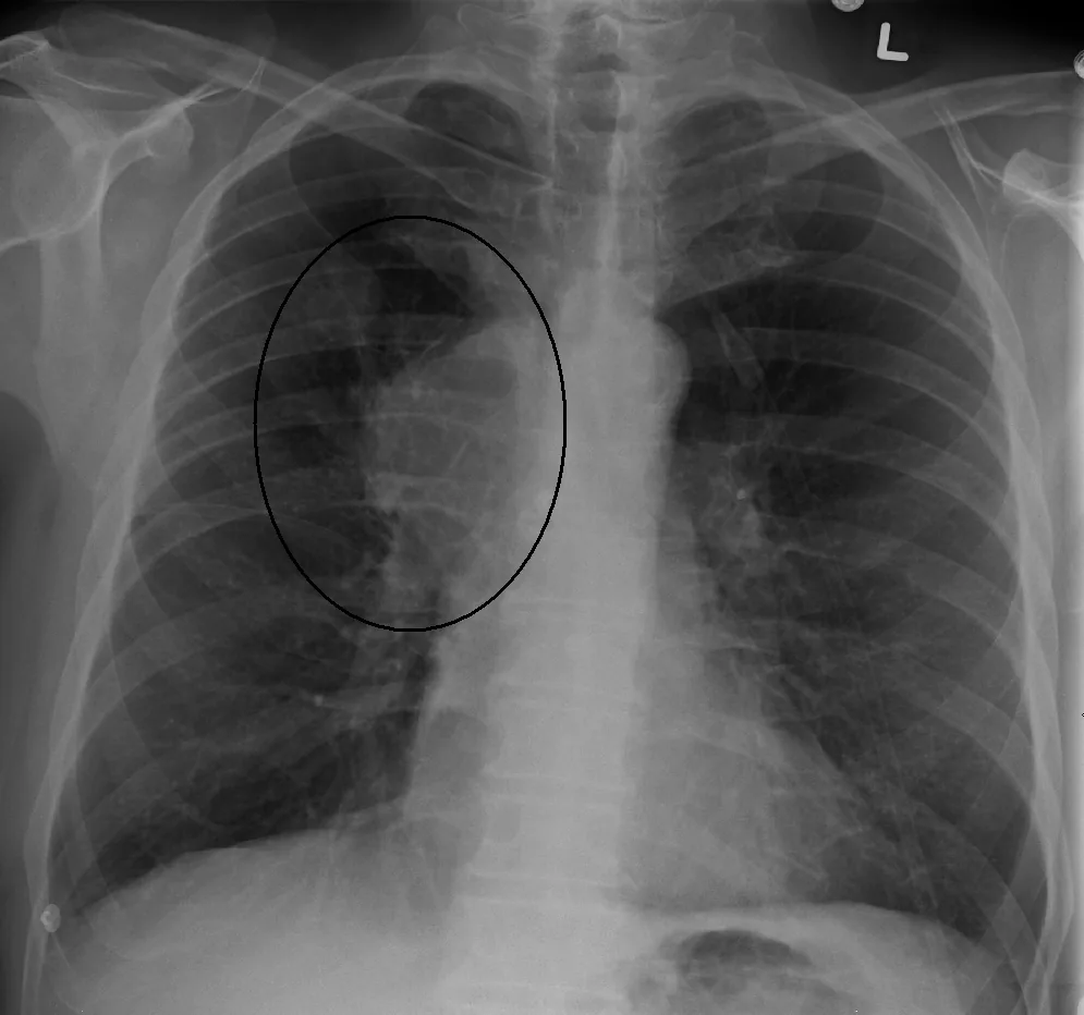 Superior vena cava syndrome – Chest X-ray: widening of the right upper mediastinum/hilum (circle) by a lung tumor causing superior vena cava syndrome