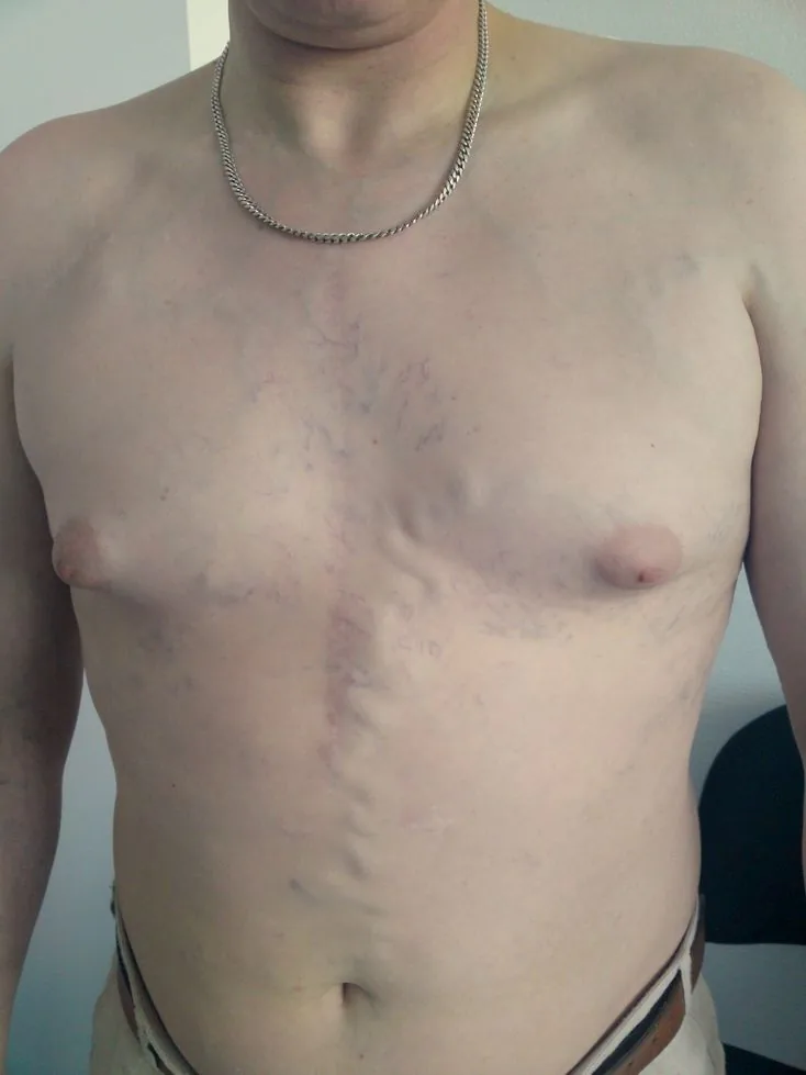 Obere Einflussstauung (Vena-cava-superior-Syndrom) – klinisches Foto: Obere Einflussstauung: deutlich erweiterte, geschlängelte oberflächliche Venen an Brustwand und Oberbauch (Kollateralkreislauf)