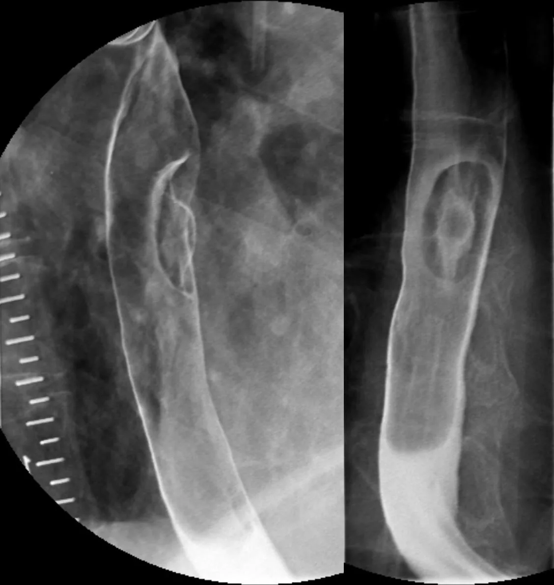 Esophageal cancer – X-ray: Barium swallow in two views: wall-based tumor with a central crater-like depression (tumor ulcer)