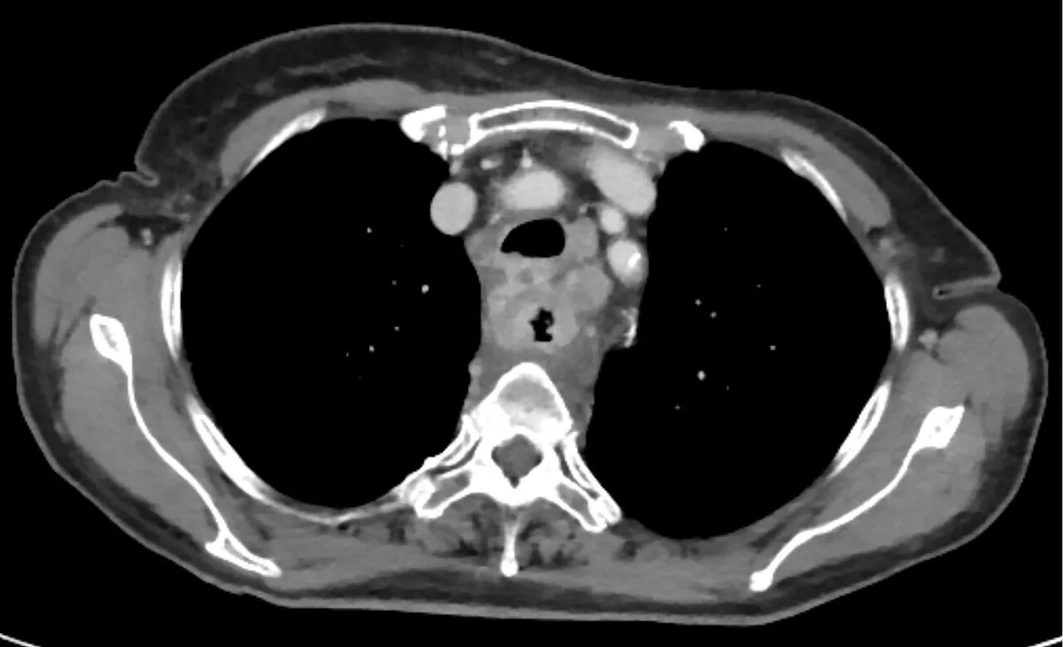 Esophageal cancer – Contrast-enhanced axial chest CT: circumferential esophageal wall thickening above the carina with enlarged lymph nodes