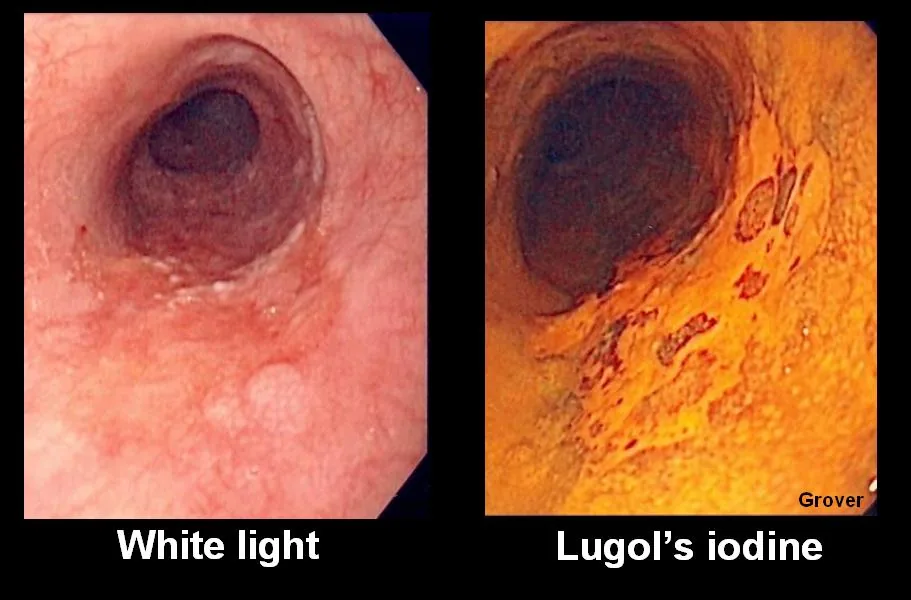 Esophageal cancer – Endoscopy of squamous cell carcinoma: subtle mucosal change in white light, demarcated as an unstained area after Lugol's iodine
