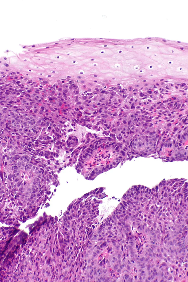 Esophageal cancer – Histology (H&E): squamous cell carcinoma with atypical squamous nests beneath the mucosal surface