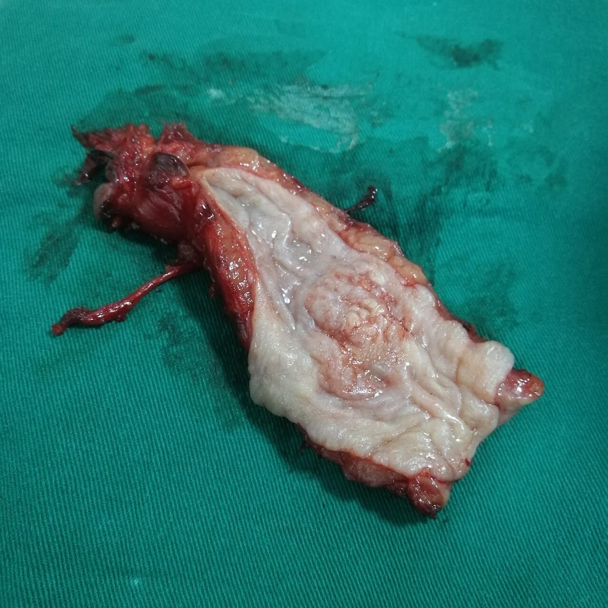 Esophageal cancer – gross specimen: Longitudinally opened esophagus: raised, ulcerated mucosal tumor