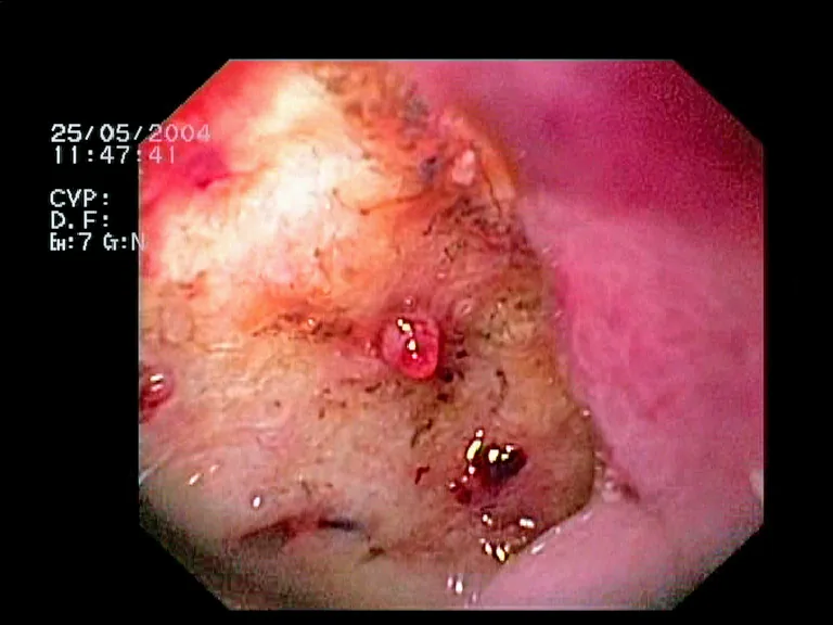 Upper gastrointestinal bleeding – endoscopy: Gastroscopy: gastric ulcer with a visible vessel in the ulcer base (Forrest IIa)