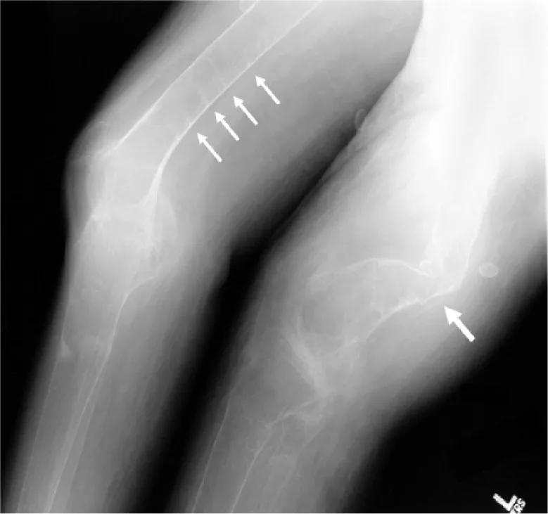 Osteomalacia and vitamin D deficiency – X-ray of the distal femurs in severe osteomalacia: bowed, demineralised bones with several Looser zones (pseudofractures, arrows)