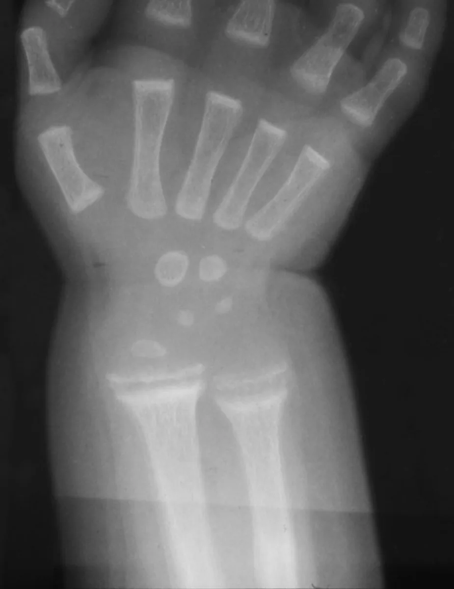 Osteomalacia and vitamin D deficiency – Wrist X-ray in active rickets: cupped, frayed and widened metaphyses of the radius and ulna
