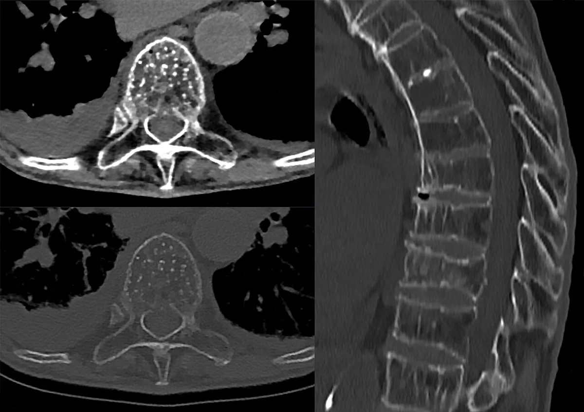 Osteoporosis – CT of the thoracic spine (axial/sagittal): markedly reduced bone density with accentuated vertical trabeculae of the vertebral bodies
