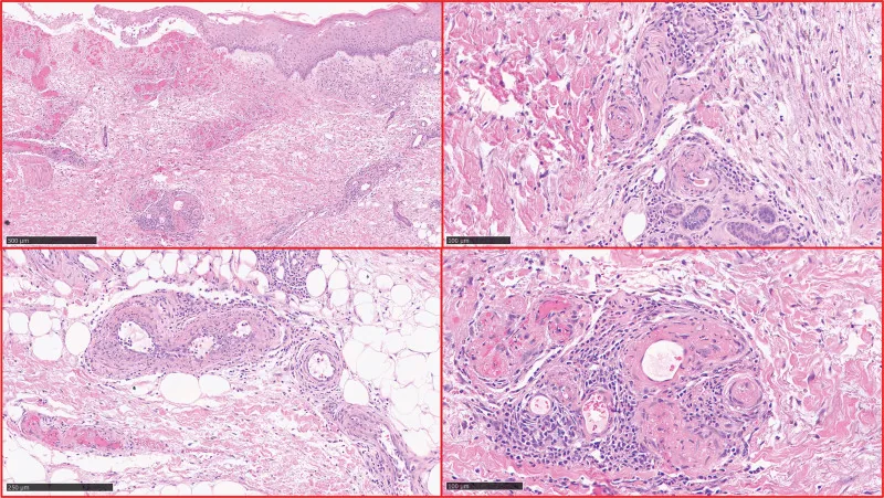 Polyarteriitis nodosa – Hautbiopsie (HE, verschiedene Vergrößerungen) bei kutaner PAN: Ulkus, Ödem und Gefäßwand mit fibrinoider Nekrose und Entzündungsinfiltrat