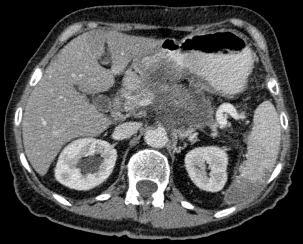 Pancreatic cancer – Contrast-enhanced CT: ill-defined hypodense mass in the pancreatic body in pancreatic cancer