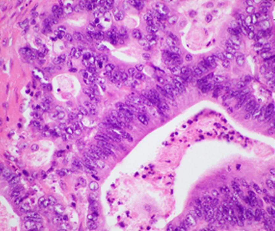 Pancreatic cancer – Histology (H&E): pancreatic ductal adenocarcinoma with atypical glands and enlarged pleomorphic nuclei