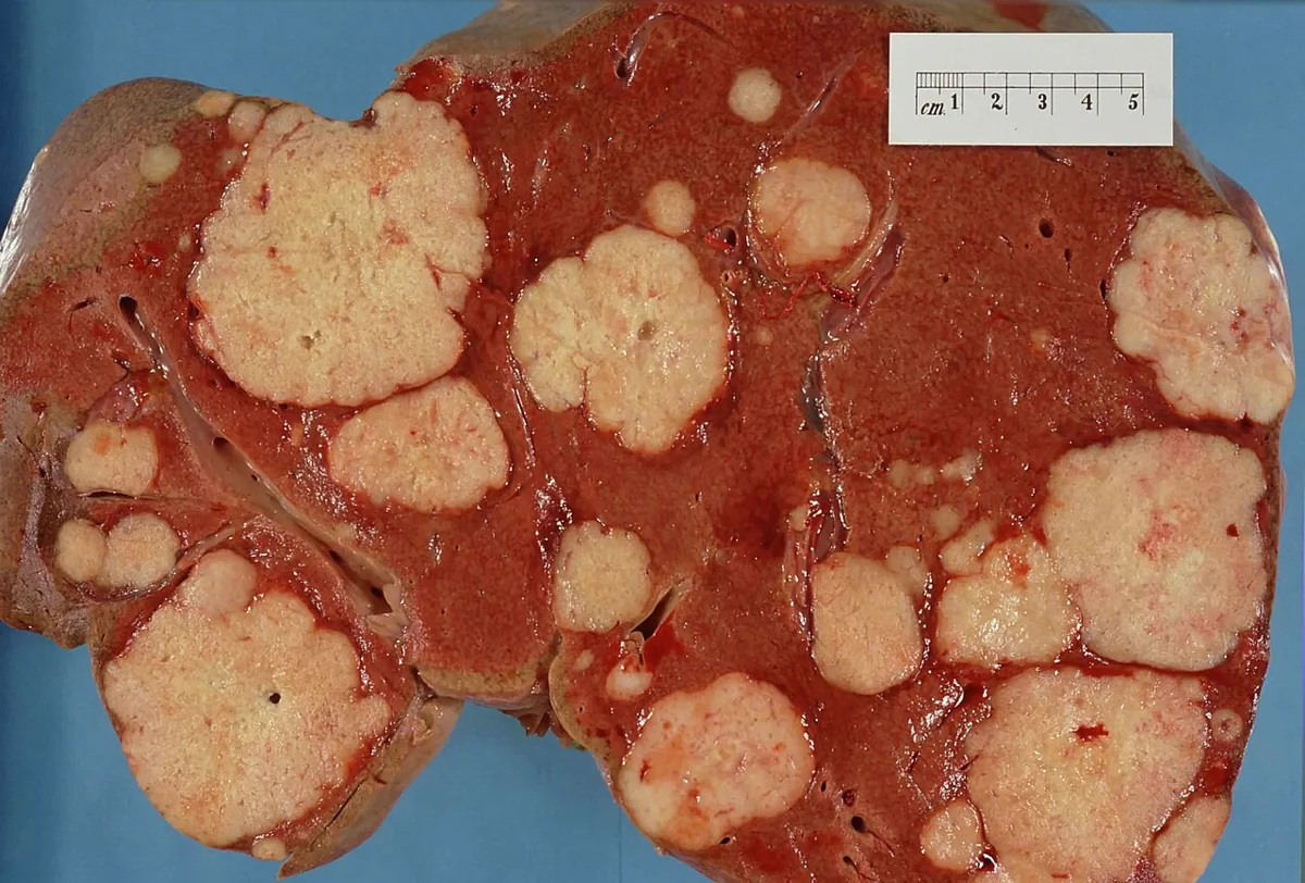 Pancreatic cancer – gross specimen: Cut surface of the liver (autopsy): numerous large pale metastases of a pancreatic carcinoma