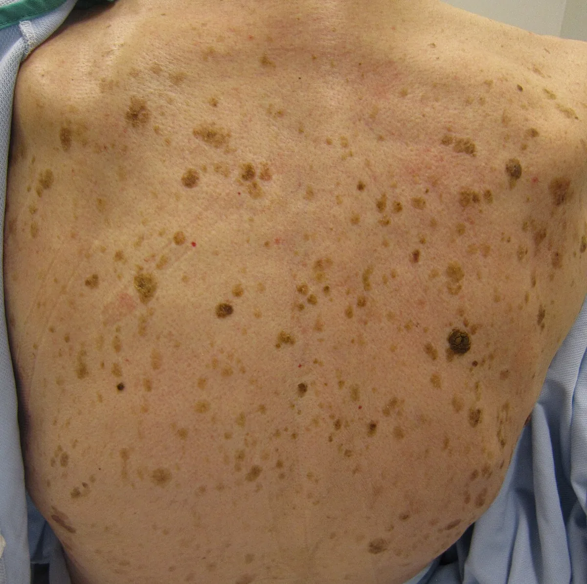 Paraneoplastic syndromes – clinical photo: Leser-Trélat sign: sudden eruption of numerous seborrheic keratoses on the back of a patient with cancer