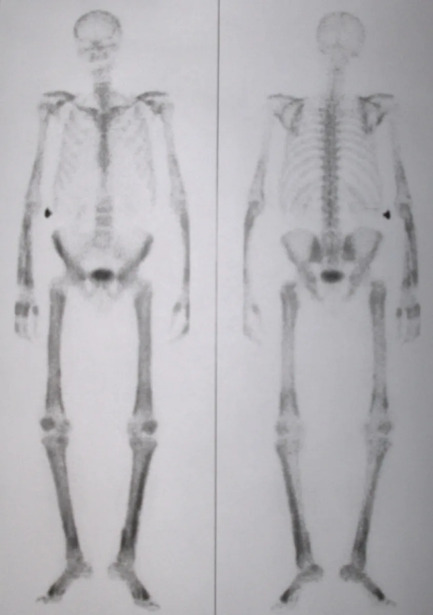 Paraneoplastic syndromes – scintigraphy: Bone scan in hypertrophic osteoarthropathy (Marie-Bamberger): symmetric, linear uptake along the long bones