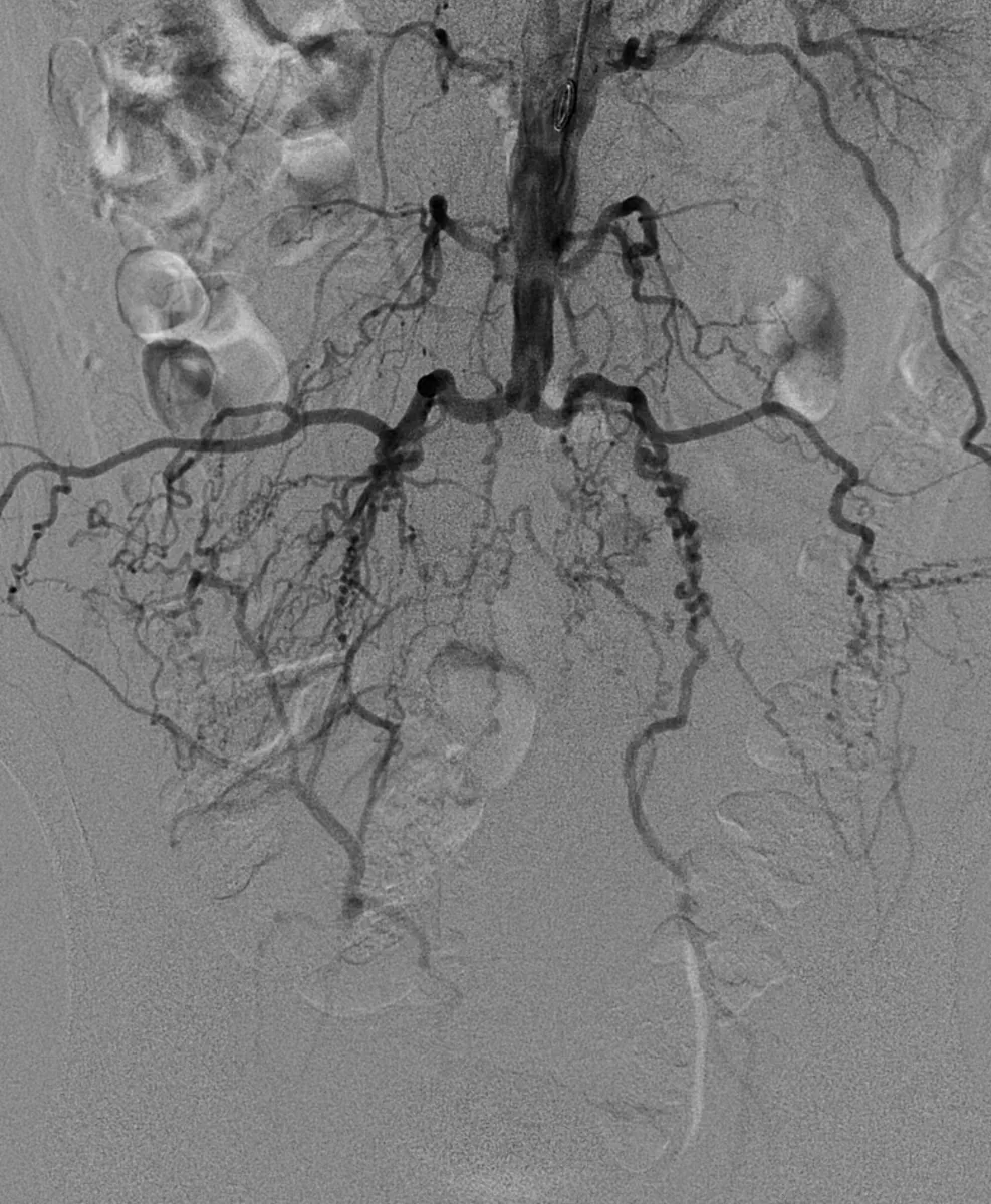 Peripheral artery disease (PAD, claudication) – Digital subtraction angiography: occlusion of the distal abdominal aorta and iliac arteries (Leriche syndrome), legs supplied via collaterals from the lumbar arteries