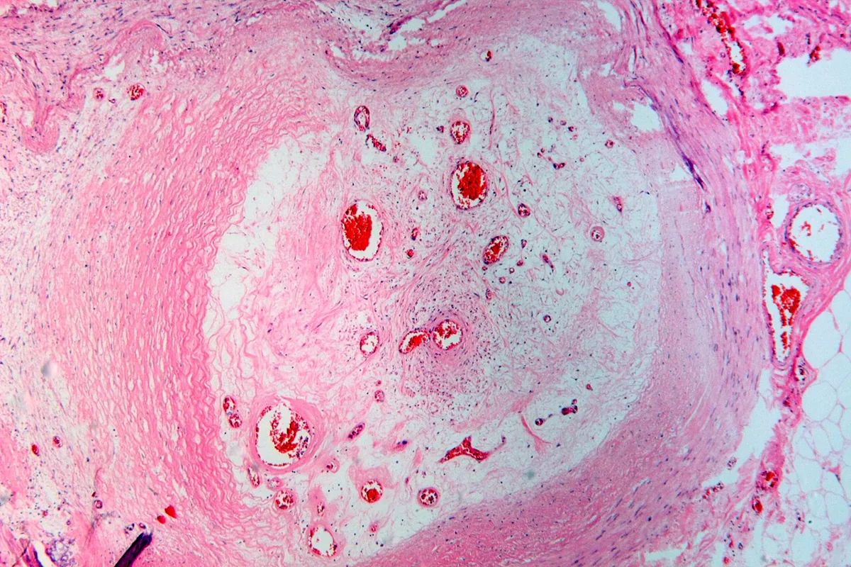 Peripheral artery disease (PAD, claudication) – Histology (H&E): lower-leg artery occluded by an old, organized thrombus with small recanalising channels
