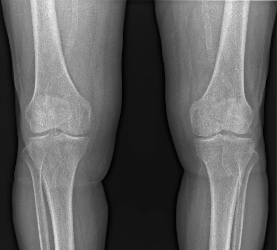 Peripheral artery disease (PAD, claudication) – X-ray of both knees: linear calcification of the femoral and popliteal arteries