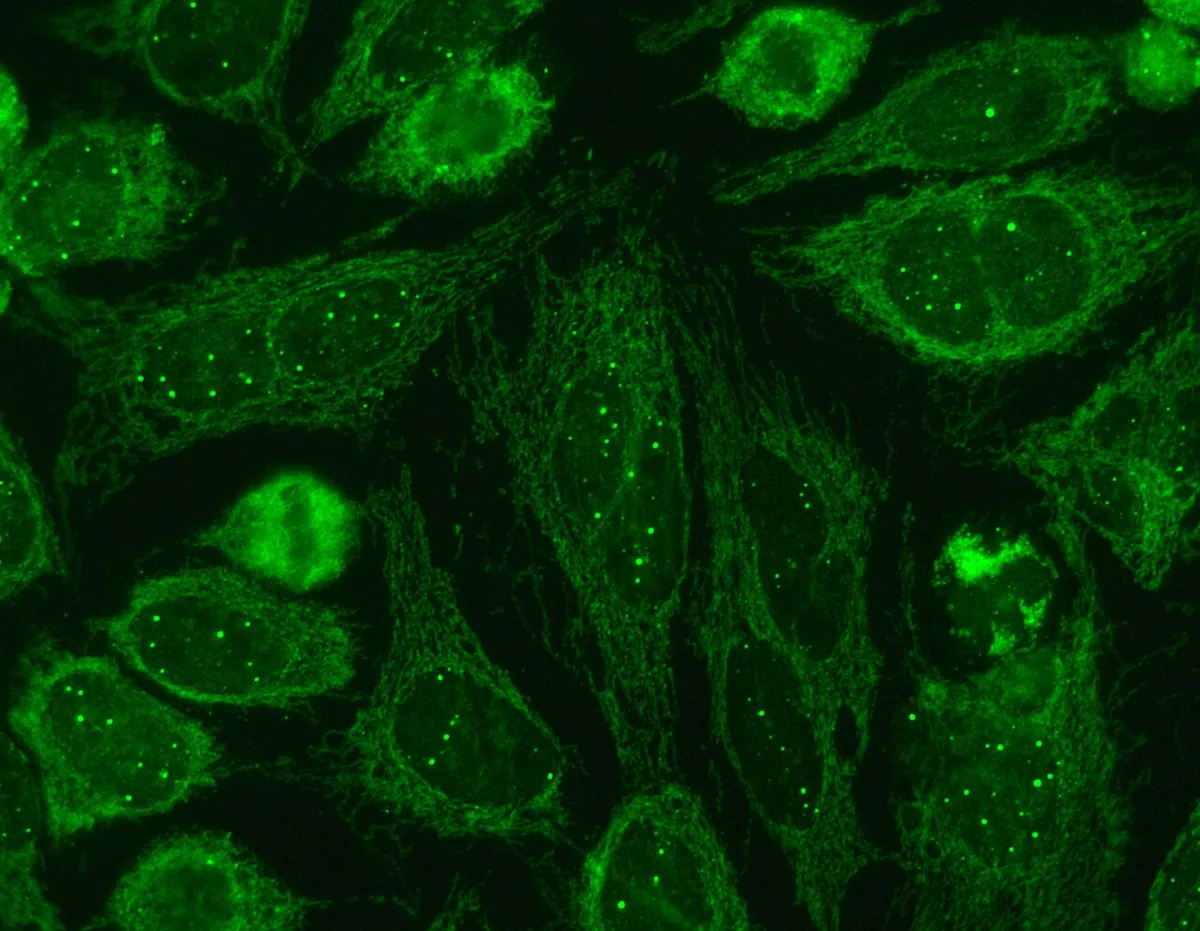 Primary biliary cholangitis (PBC) – Indirect immunofluorescence on HEp-2 cells: filamentous, network-like cytoplasmic staining (antimitochondrial antibodies) and multiple nuclear dots (Sp100 antibodies)