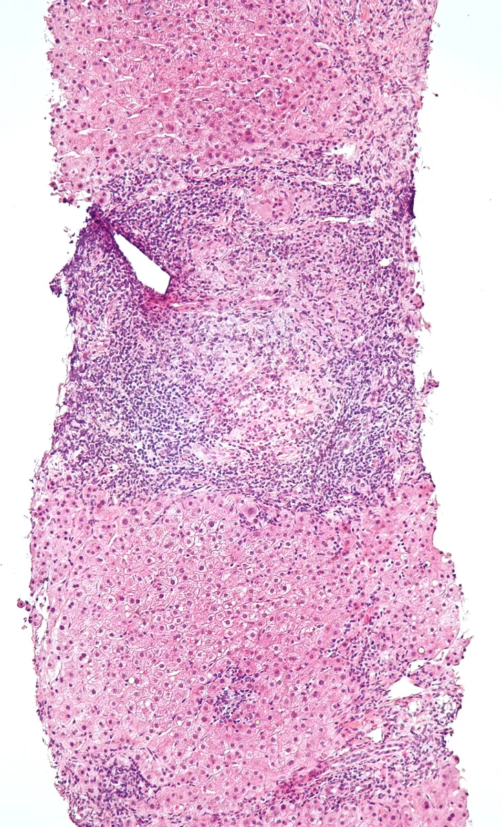 Primary biliary cholangitis (PBC) – Histology (H&E), liver biopsy in primary biliary cholangitis: dense portal inflammation around bile ducts with lymphocytic bile duct injury