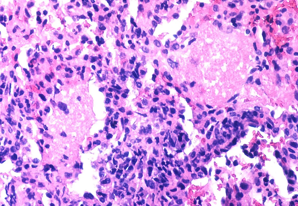 Pneumocystis-Pneumonie (PcP) – Histologie (HE): schaumiges, eosinophiles Exsudat in den Alveolen und interstitielle Entzündung bei Pneumocystis-Pneumonie