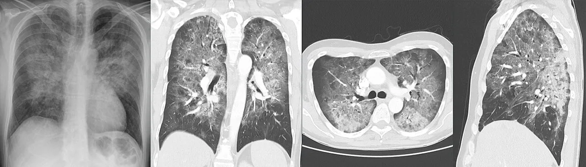 Pneumocystis-Pneumonie (PcP) – Röntgen-Thorax und CT bei HIV-Infektion: beidseitige, diffuse milchglasartige Verdichtungen mit Betonung der Lungenmitte (Pneumocystis-Pneumonie)