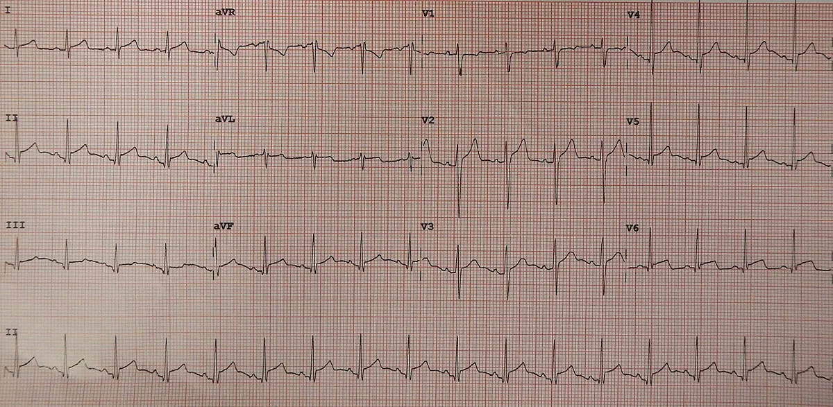 Acute pericarditis – 12-lead ECG: diffuse, upwardly concave ST elevation in several leads with PR depression; reciprocal pattern in aVR