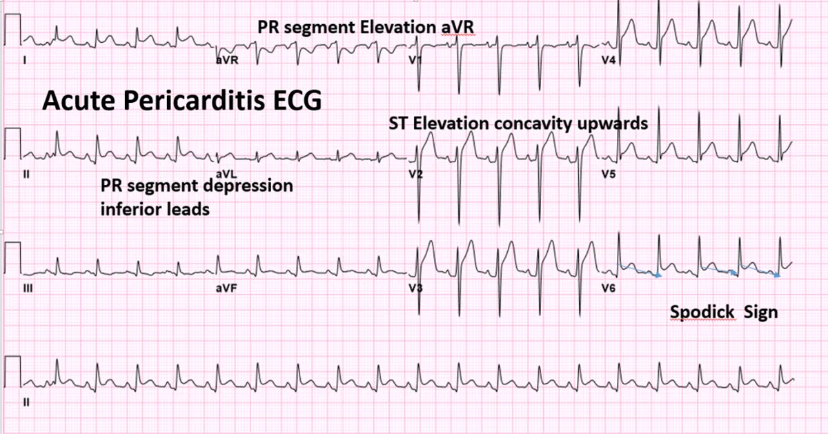 Acute pericarditis – 12-lead ECG in acute pericarditis (labelled): concave ST elevation, inferior PR depression, PR elevation in aVR, Spodick sign