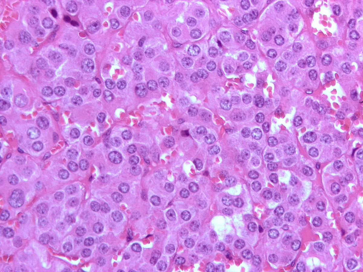 Pheochromocytoma – Histology of pheochromocytoma (H&E): nests (Zellballen) of large polygonal cells with finely granular basophilic cytoplasm