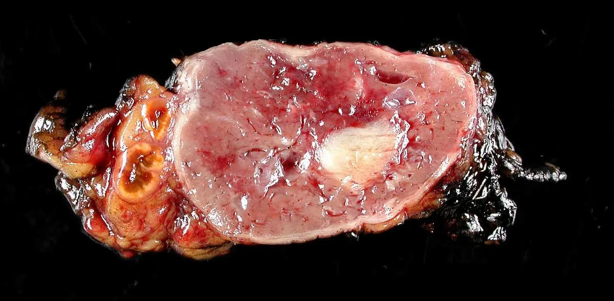 Pheochromocytoma – gross specimen: Pheochromocytoma, cut surface: reddish-brown, partly hemorrhagic tumor within the adrenal gland