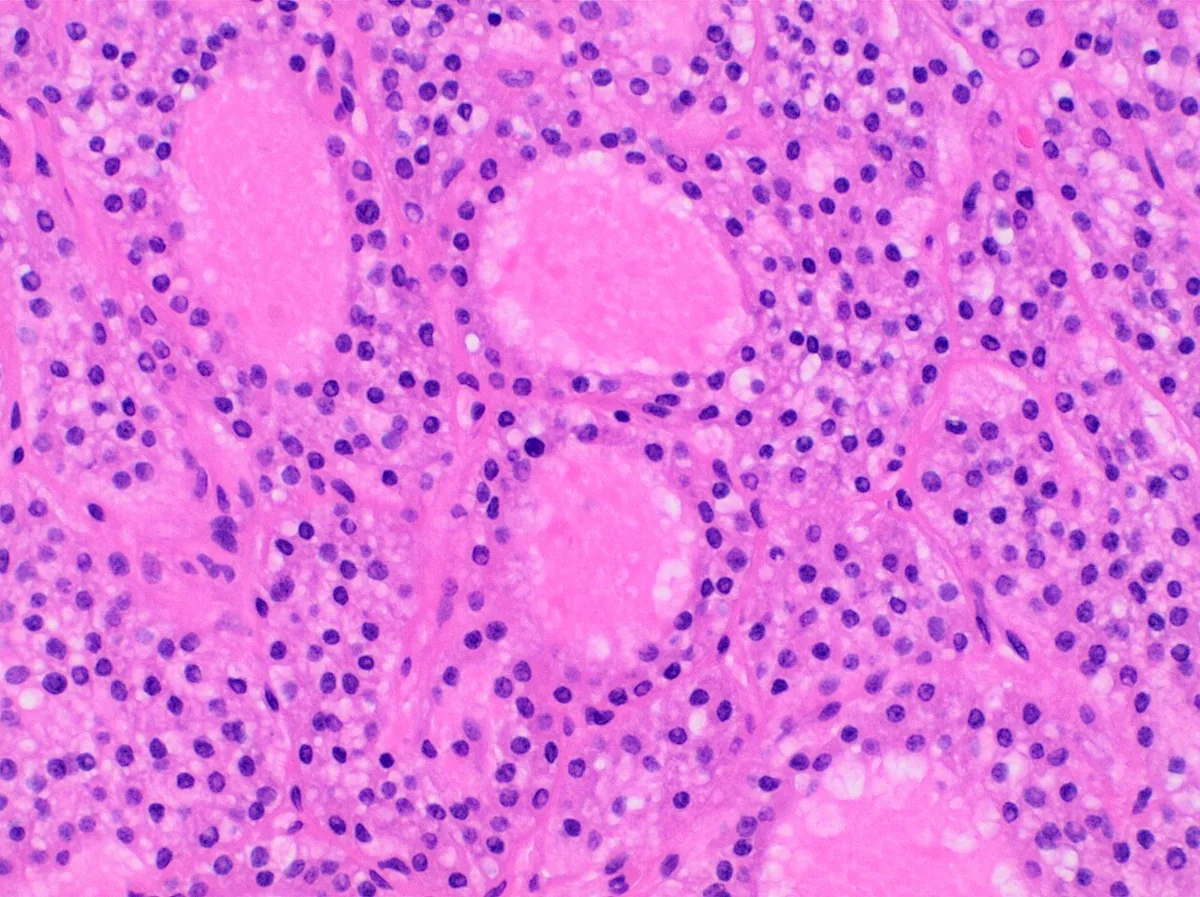 Primary hyperparathyroidism – Histology of a parathyroid adenoma (H&E): densely packed chief cells without fat, occasional follicle-like structures
