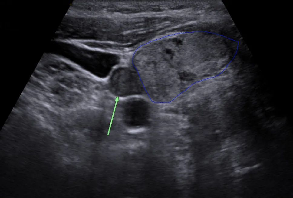Primary hyperparathyroidism – Transverse neck ultrasound: oval hypoechoic nodule posterior to the thyroid (parathyroid adenoma)