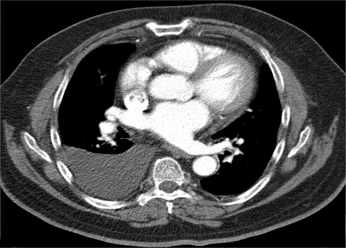 Pleural effusion – Axial CT (soft-tissue window): right pleural effusion as a crescent of water-density fluid in the dependent posterior pleural space
