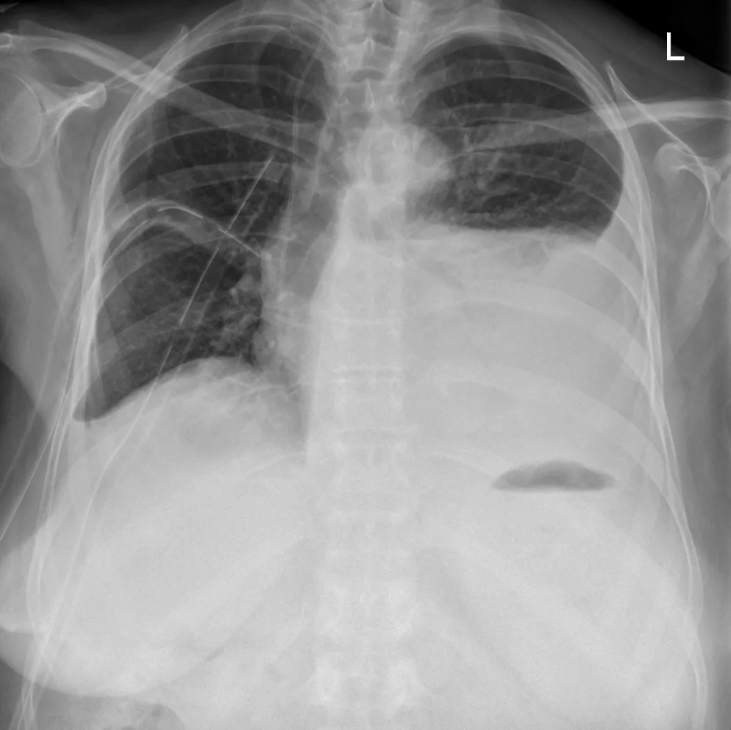 Pleural effusion – Upright chest X-ray: large left pleural effusion with homogeneous basal opacity and a laterally ascending border