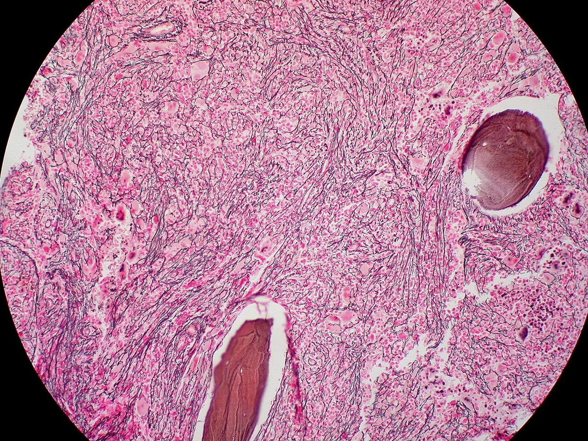 Primary myelofibrosis – histology: Bone marrow biopsy, silver (reticulin) stain: dense network of increased, thickened reticulin fibers in myelofibrosis
