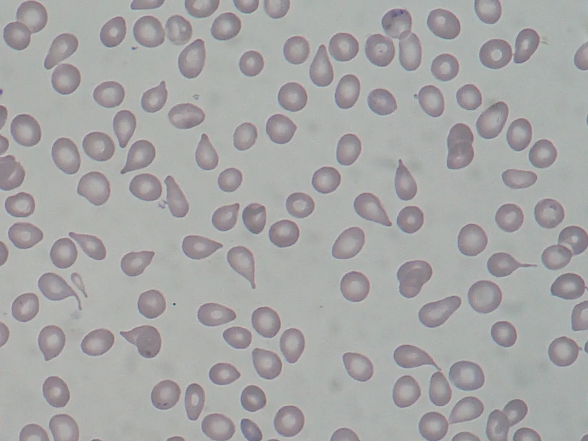 Primary myelofibrosis – Blood smear: numerous teardrop cells (dacrocytes), typical of myelofibrosis