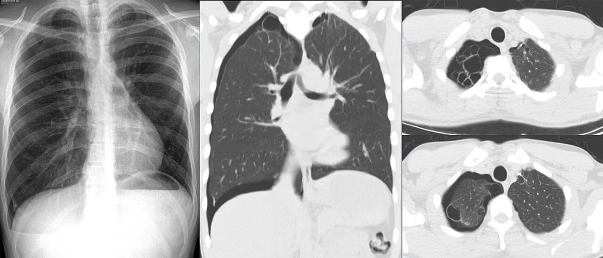 Pneumothorax (collapsed lung) – X-ray and CT: right spontaneous pneumothorax with apical bullae (emphysematous blebs at the lung apex)