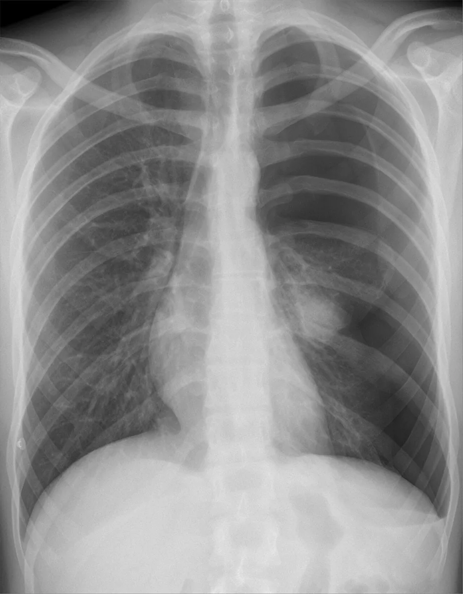 Pneumothorax (collapsed lung) – Chest X-ray (PA): left tension pneumothorax with the lung collapsed towards the hilum, absent peripheral markings and mediastinal shift to the right