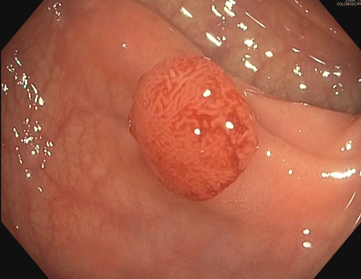Colorectal adenomas (polyps) – Colonoscopy: 6–7 mm sessile polyp in the sigmoid colon with a tubular surface pattern (tubular adenoma)