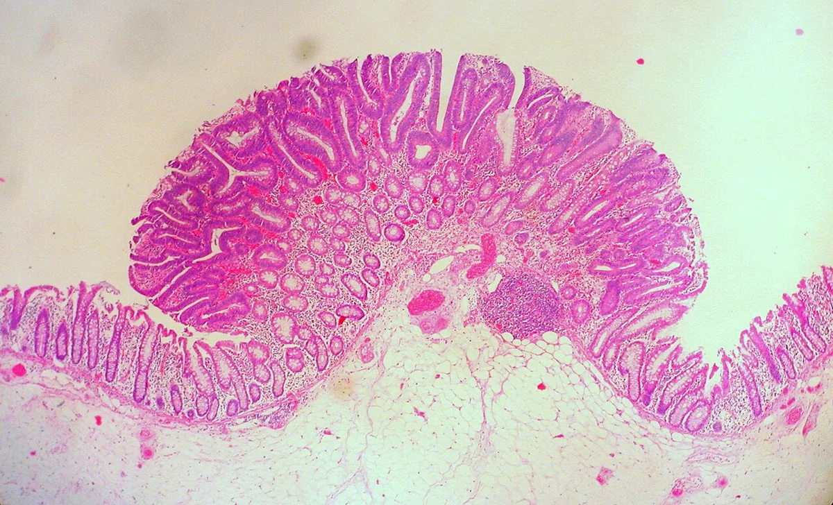 Colorectal adenomas (polyps) – Histology (H&E, low power): tubular adenoma with crowded, darkly stained dysplastic glands