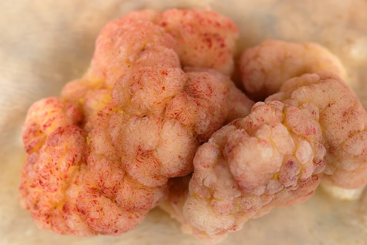 Colorectal adenomas (polyps) – gross specimen: Large villous adenoma of the sigmoid colon with a frond-like, cauliflower surface