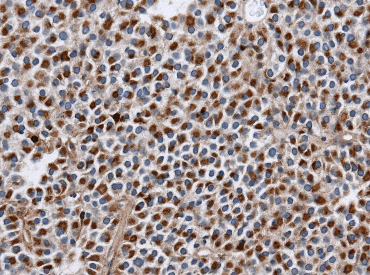 Hyperprolaktinämie und Prolaktinom – Histologie: Prolaktinom, Immunhistochemie: kräftige Prolaktin-Anfärbung (braun) der Adenomzellen