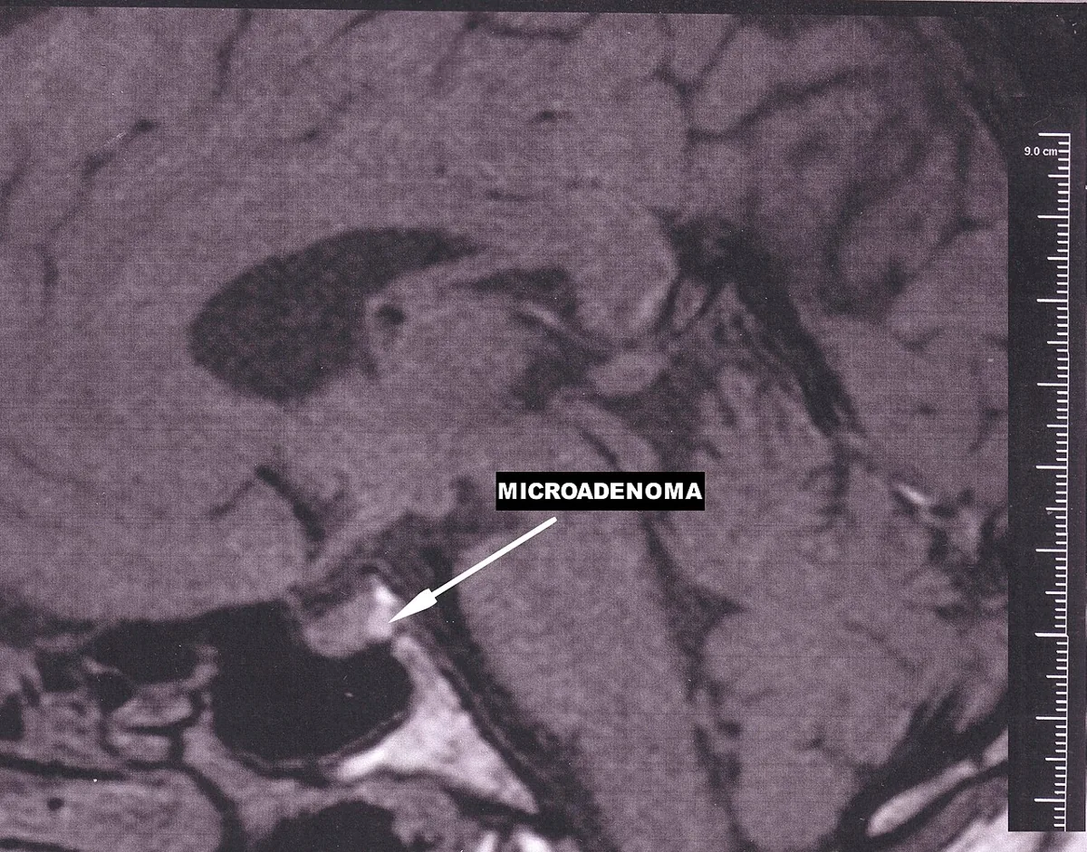 Hyperprolaktinämie und Prolaktinom – MRT des Kopfes sagittal: kleines Hypophysenadenom (Mikroadenom, Pfeil) in der Sella turcica