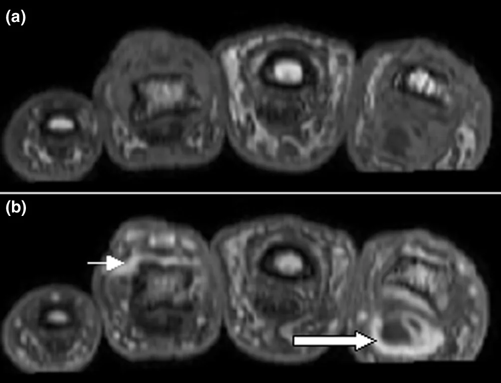 Psoriatic arthritis – MRI in dactylitis (axial, post contrast): enhancement around the flexor tendon and in the soft tissue of one finger (arrows)