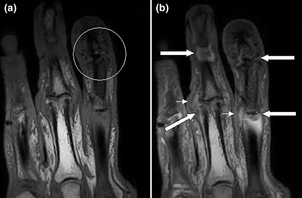 Psoriatic arthritis – MRI of the fingers (coronal, pre/post contrast): synovitis and inflammation at finger joints and tendon insertions (arrows)