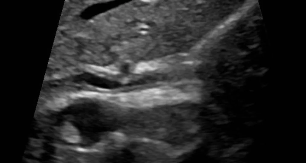 Primary sclerosing cholangitis (PSC) – Ultrasound in sclerosing cholangitis: bile duct with a thickened, echogenic wall in longitudinal section